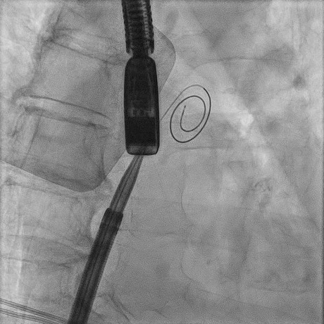 Fluoroscopic image of transseptal device delivery over the LightningWire guidewire
